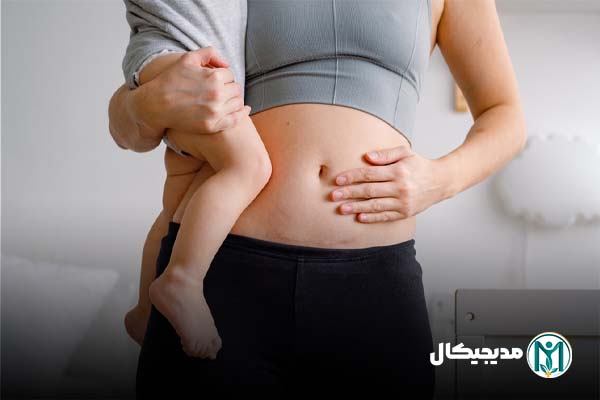 بیرون زدگی بخیه در سزارین
