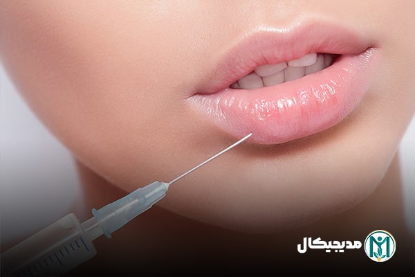تزریق فیلر لب طبیعی
