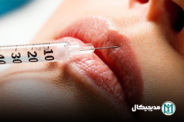 ژل لب حجم دهنده