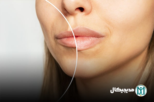 قیمت فیلر لب