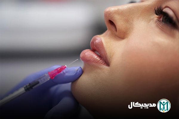 انواع تزریق ژل لب