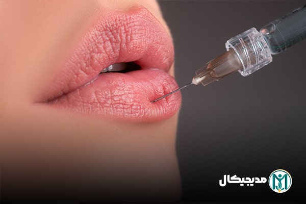 قیمت ژل برای تزریق لب