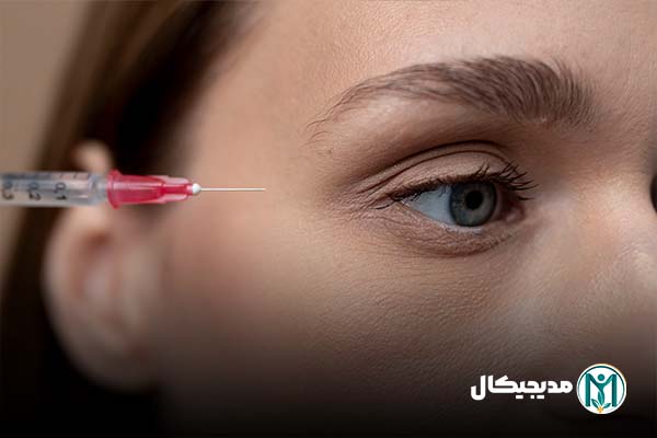انواع فیلر زیر چشم