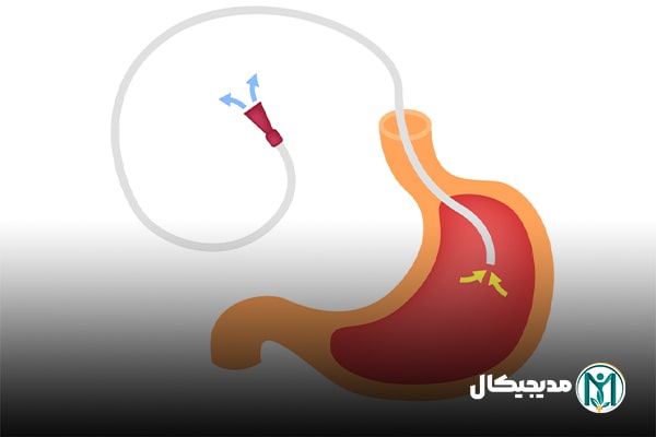 سوند نازوگاستریک