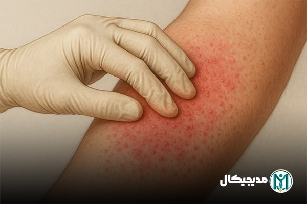 حساسیت به لاتکس